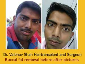 Hair transplant in Mumbai, India - Dr. Vaibhav Shah! Cosmetic Surgery & Hair Transplant in Mumbai