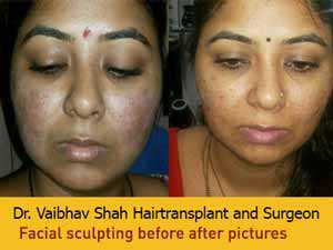 Hair transplant in Mumbai, India - Dr. Vaibhav Shah! Cosmetic Surgery & Hair Transplant in Mumbai