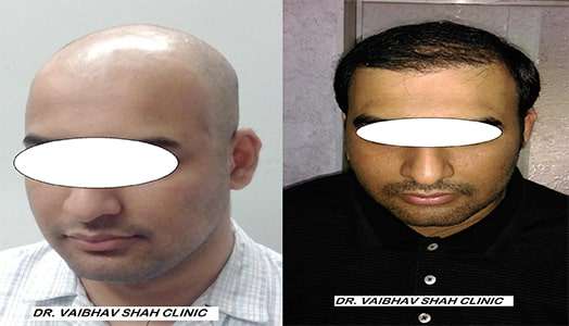 Hair Transplant Before After, Photos, India - Dr Vaibhav Shah